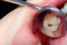 The Latest Dental Filling Technologies