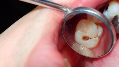 The Latest Dental Filling Technologies