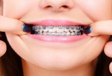 Benefits of Choosing Metal Braces for Kids in Johns Creek