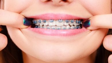 Benefits of Choosing Metal Braces for Kids in Johns Creek