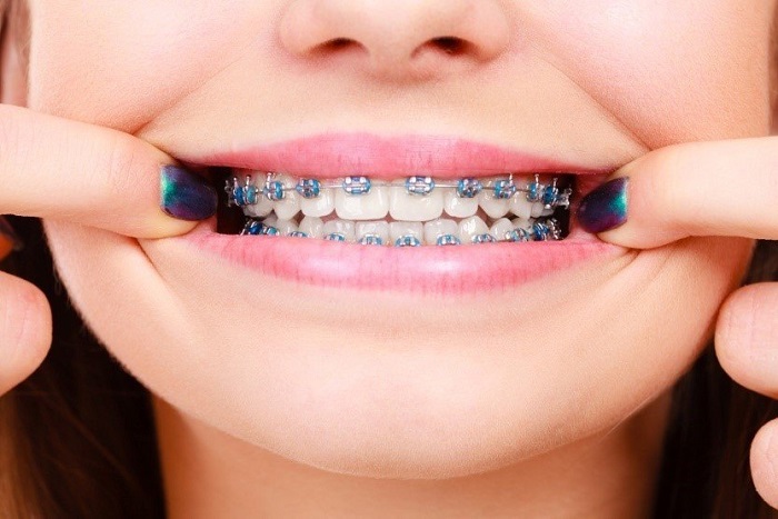 Benefits of Choosing Metal Braces for Kids in Johns Creek
