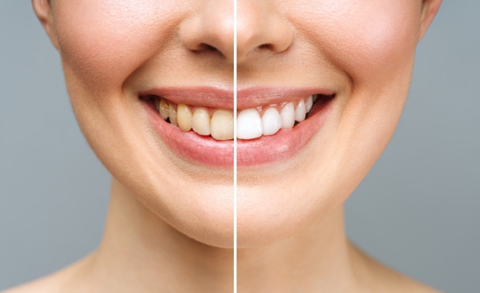 teeth whitening 1