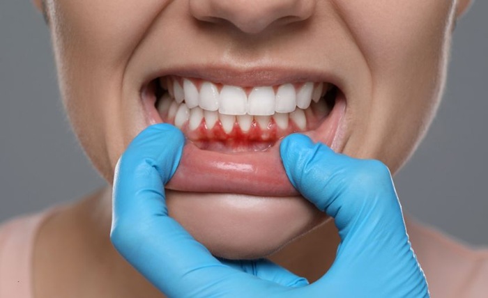 Winter Smog and Gum Health