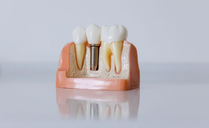 Implant Supported Dentures Offer Stability and Confidence